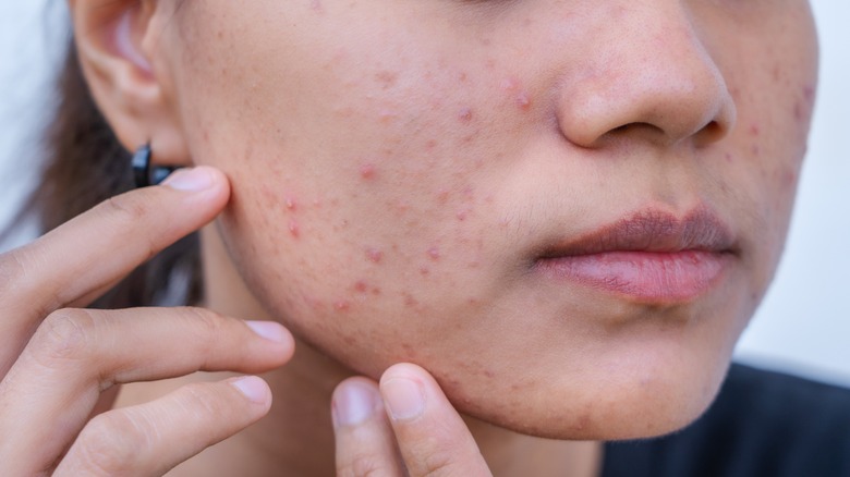 woman with acne on face